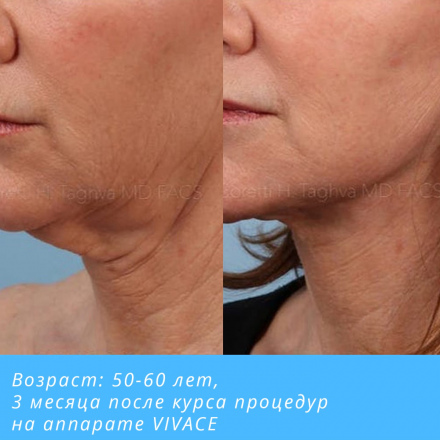 Выраженное омоложение, подтяжка, улучшение качества кожи
