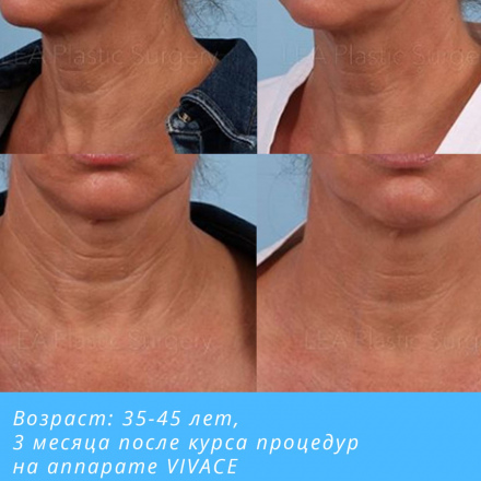 Омоложение зоны игольчатый рф лифтинг шеи и декольте, разглаживание морщин, плотность кожи