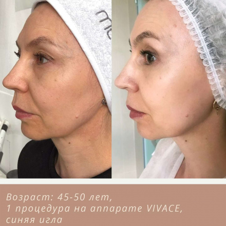 Подтянутая, упругая и ровная кожа после 1-й процедуры VIVACE (Виваче)