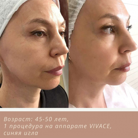 Ровная текстура кожи, упругость, подтяжка лица без операции