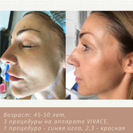 Устранили несовершенства кожи, получили ровный тон и текстуру, плотность и выраженный лифтинг (фото до/после)
