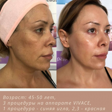 Стимулирование образования новго коллагена и эластина привело к качественным положительным изменениям (фото до/после)