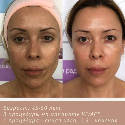 Выраженное омложение после курса из 3-х процедур (фото до/после). Кожа подтянулась, уплотнилась, появился здоровый цвет лица