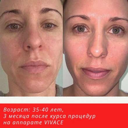 Улушение качества кожи и устранение несовершенств