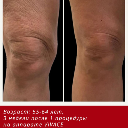 Омоложение за счет сокращения избытка тканей, без операции (фото до/после)